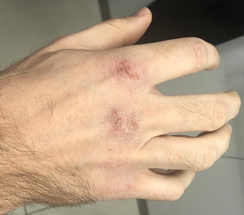 Matt's dry, cracked knuckles and hand.
