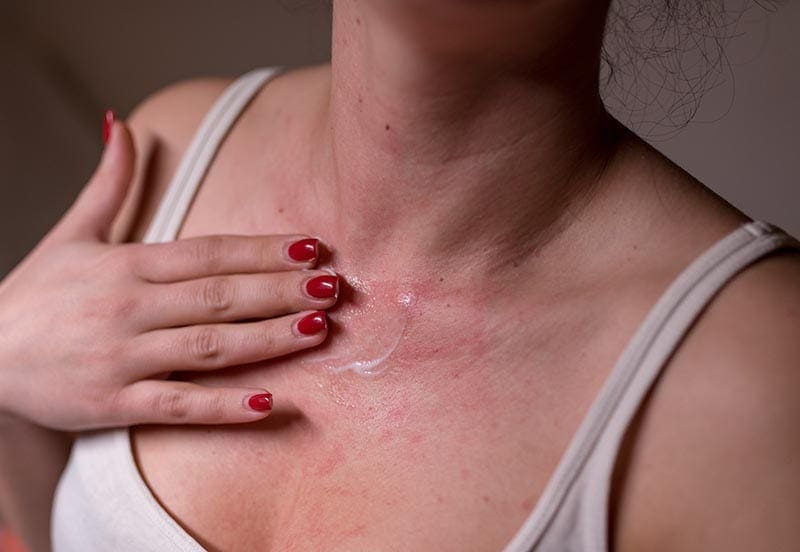 Woman with sensitive skin applying moisturiser on her chest